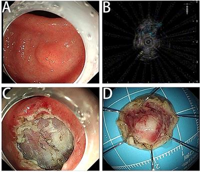 Endoscopic submucosal excavation for gastric plexiform fibromyxoma: A case report and systematic review of literature